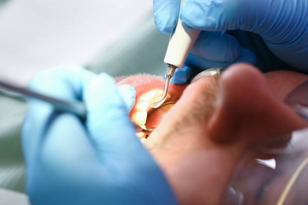 Best Emergency Treatment for Dental Infections or Abscesses in Marble Hill, MO